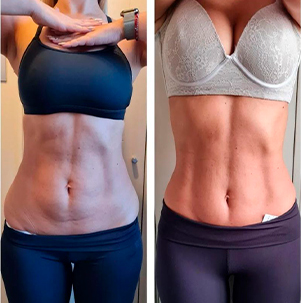 medicina-estetica/prosculpt - clinicamadeleyne.cl